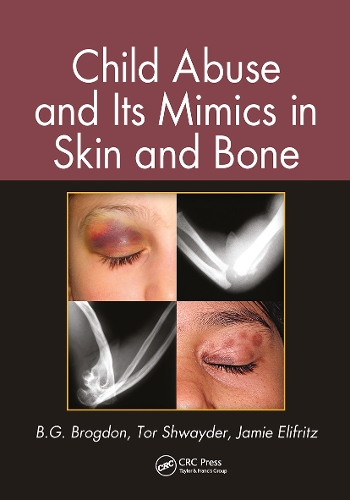 Child Abuse and its Mimics in Skin and Bone.