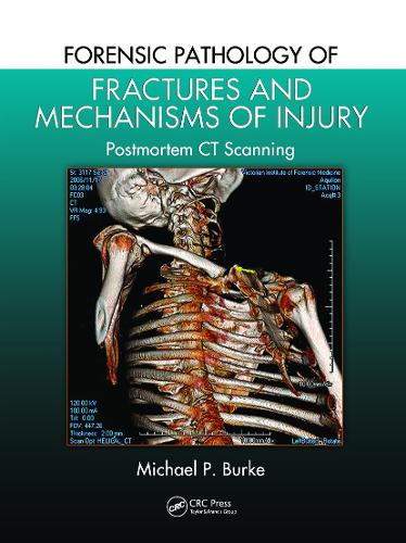 Forensic Pathology of Fractures and Mechanisms of Injury: Postmortem CT Scanning.